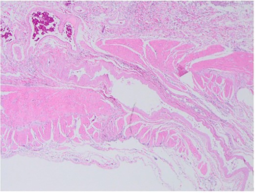 Histopathological findings show dilated arteries and veins from the submucosal layer to the mesentery.