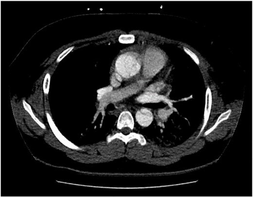 Computed tomography aortogram Axial Image of Stanford Type-A Aortic Dissection.