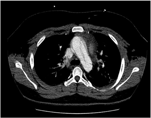 Computed tomography aortogram Axial Image of Stanford Type-A Aortic Dissection extending into arch and descending thoracic aorta.