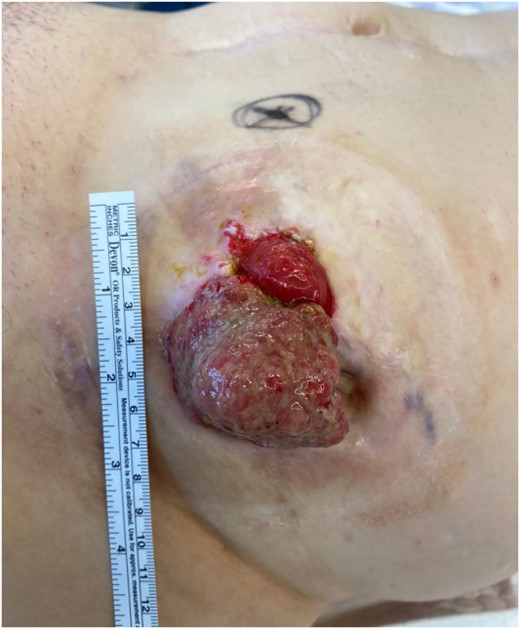 Large, nonobstructive tumour of the ileostomy with vulnerable mucosa.
