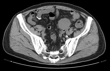 Contrast-enhanced CT showed a well-defined mass in contact with the small intestine that had heterogeneous enhancement.