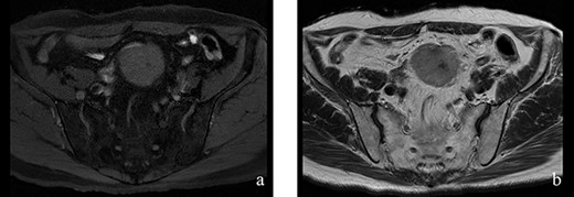 Figure 2: (a, b) The tumor had hypointensity on the T1-weighted images and mild hyperintensity on the T2-weighted images.