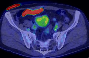 FDG-PET-CT showed FDG uptake in the tumor, with a SUVmax of 3.4.
