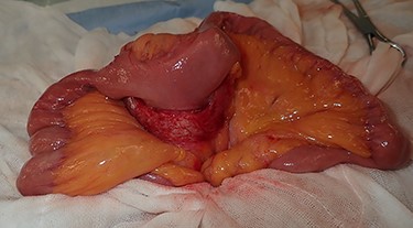 The tumor that developed from the mesentery was resected under a minilaparotomy.