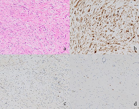 (a) Tumor cells comprised of fibroblasts were proliferating (×100). (b, c, d) The tumor cells were positive for β-catenin and negative for S-100 and c-kit (×50).