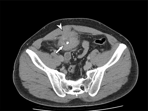 Axial CT image of the pelvic lesion. Arrow indicates central calcification. Arrowhead indicates involvement of anterior abdominal wall.