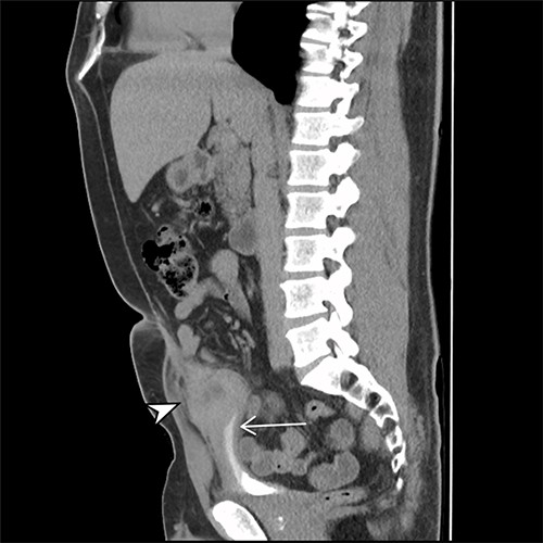 Sagittal CT cystogram. Arrowhead indicates involvement of anterior abdominal wall. Arrow indicates association of lesion with the dome of the bladder.