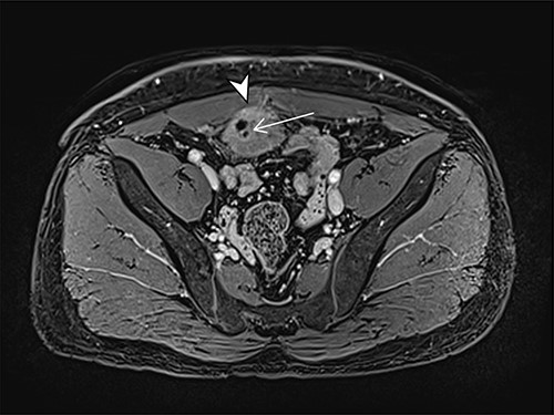 Axial MRI image of lesion. Arrowhead indicated involvement with the rectus abdominis. Arrow indicates lesion and calcific focus.