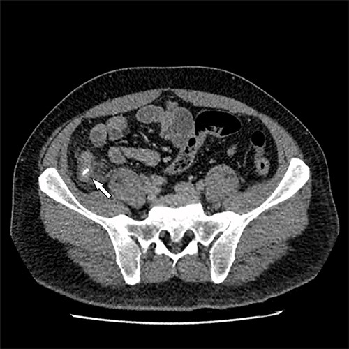 Axial CT image. Arrow indicates appendicolith present within the appendix, with minor fat stranding surrounding the appendix.