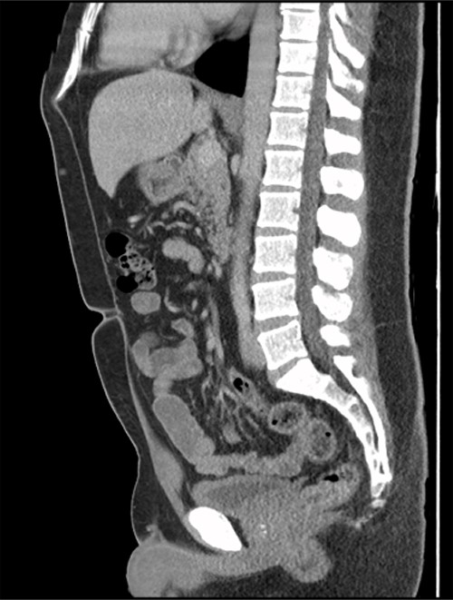 Sagittal CT image. No obvious abnormalities at the dome of the bladder.