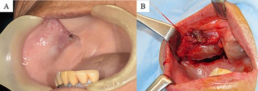 (A) Intraoral findings: bulge sized 30 mm, soft and elastic in consistency, involving the right buccal mucosa. (B) Intraoperative findings: the tumor is covered with a white capsule, and the border with the surrounding organization is clear.
