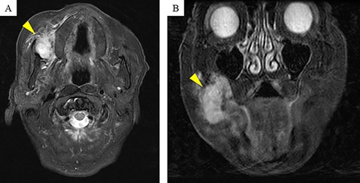 Magnetic resonance imaging (MRI) findings: contrast-enhanced T2-weighted MRI shows a high signal mass (arrow head) of size 31 × 25 × 30 mm in the right buccal mucosa.
