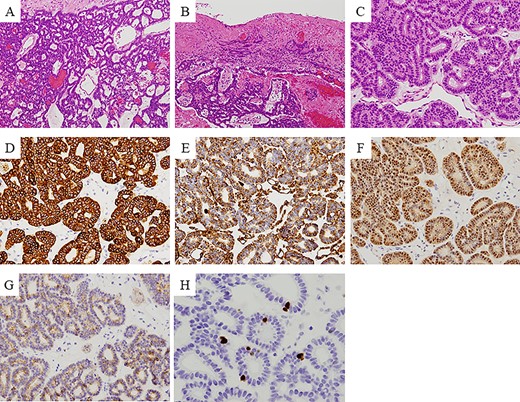 Immunohistochemical findings: the lesion is a well-circumscribed and encapsulated tumor mass (A), but the overlying mucosa is discontinuous in some areas caused by chronic traumatic irritation with recurrent hemorrhage (B). The tumor is composed of proliferating epithelial cells basically arranged in branching and interconnecting canalicular strands or cords lined by a single-layered columnar cells, and these canalicular structures dilate in various degrees resulting in formation of cystic structures (A, C). Immunohistochemical examination revealed that the tumor cells were positive for 34βE12, vimentin, S100 and c-KIT (D–G), and negative for SMA and p63. Ki-67 positive cells were less than 5% per high-power view field (H).