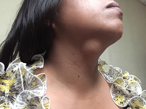 Clinical image of the lesion during physical examination.