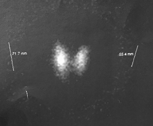 Thyroid gram range 75 mCi I 131 with normal uptake 16% in normal thyroid situation with preserved shape and function.