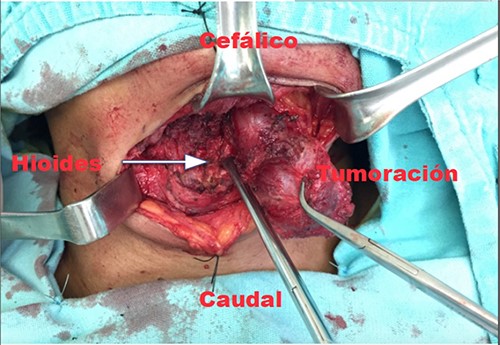 Intraoperative exposure of the right cervicotomy of the hyoid bone in relation to the tumor (arrow).