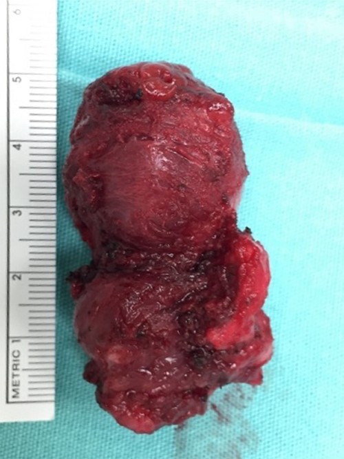 In bloc resection of thyroglossal cyst including hyoid bone segment.