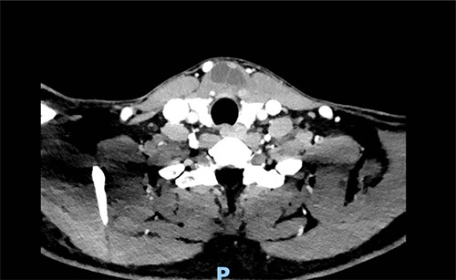 Solid cystic tumor, with multiple septa, localized on the midline adjacent to the thyroid gland.