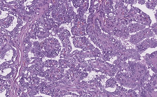 Papillary thyroid carcinoma: true papillae with multiple branching, stromal stalk with microvessels (left). Note the optically clear (empty, ground-glass) nuclei with thick nuclear membrane (H&E, high power).