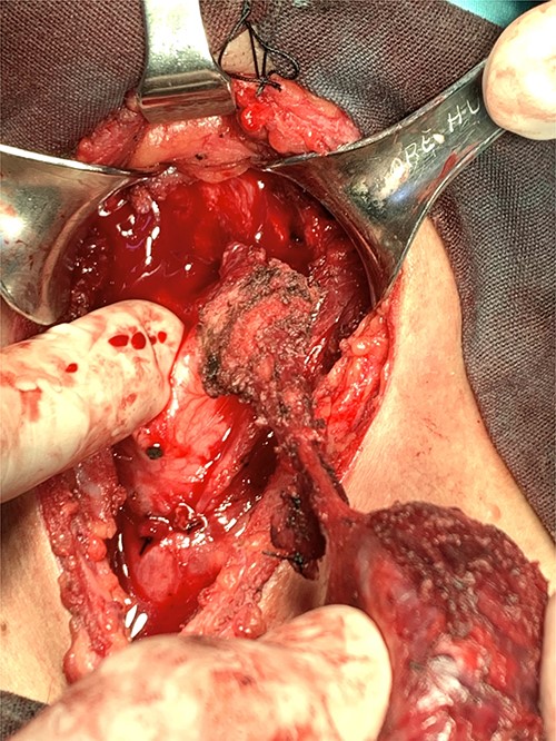 Removing the thyroglossal duct cyst carcinoma.