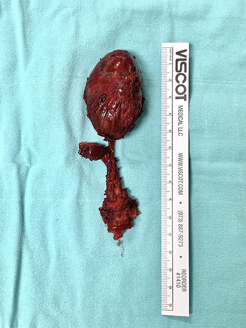 Thyroglossal duct cyst related to a papillary-type thyroid cancer.
