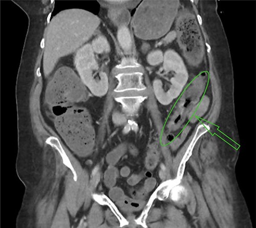 Mural thickening of sigmoid colon.