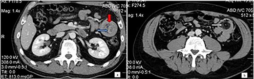 Computed tomography of the abdomen: Bowel-within-bowel configuration in which the layers of the bowel are duplicated forming two concentric enhancing rings by the inner bowel (blue arrow) and the folded edge of the outer bowel (red arrow). Invaginated mesenteric fat and vessels are also visible (a). Even further distally within the jejunum the lead point is visualized as an intraluminal mass with fat attenuation, compatible with lipoma (arrow) (b).