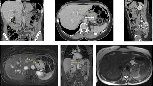Radiology (a) CT scan coronal view showing the gallbladder filled with radiolucent stones (orange arrow) and the GIST in the stomach (green arrow). (b) CT scan axial view showing the gastric GIST in the submucosal tissue (green arrow). (c) CT scan sagittal view showing the gastric GIST on the posterior wall of the stomach (orange arrow). (d) MRI axial view showing the tumour with a pneumatocele (green arrow). (e) MRI coronal view showing the tumour on the posterior wall of the stomach (orange arrow) with the visible pneumatocele. (f) T2 weighted MRI axial view showing the GIST dimensions.