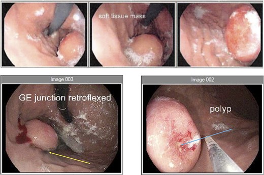 Endoscopy (a) gastroscope showing the GIST on the posterior gastric wall and its relationship to the gastro-oesophageal junction. (b) second gastroscope with injection of methylene blue (yellow arrow) to mark the tumour borders. (c) mucosal ulceration due to tumour enlargement (blue arrow) on the second gastroscope 6 weeks later.