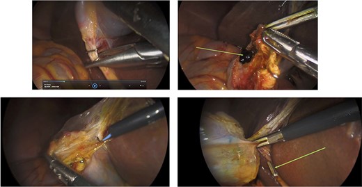 Surgery: laparoscopic cholecystectomy. (a) clipping of the common bile duct. (b) retrograde dissection of the fundus of the gallbladder. (c) iatrogenic gallbladder injury and spillage of pigment stones (green arrow). (d) completion of the retrograde dissection with visualization of the cystic duct stump (green arrow).