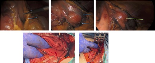 Surgery: gastric wedge resection. (a) laparoscopic entry into the lesser sac through the gastro-colonic ligament (blue arrow). (b) methylene blue markings visible on the serosal layer of the stomach (blue arrows) to delineate the tumour margins. (c) complete mobilization of the gastro-colic and gastro-splenic ligament and visualization of the gastric GIST (green arrow) on the posterior wall of the stomach. (d) macroscopically clear tumour margins post GIST resection. (e) posterior gastric wall sutured closure (yellow arrow).