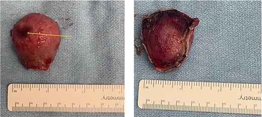 Gross pathology. (a) mucosal view with ulceration of the gastric mucosa (orange arrow). (b) serosal view showing the gastric serosal layer.