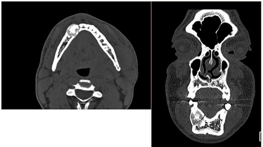 CT scan of the facial bones. These CT images in the axial (left) and coronal (right) view depict the 2.3 cm mandibular mass with pathologic fracture on the medial aspect as well as a non-displaced left mandibular angle fracture.