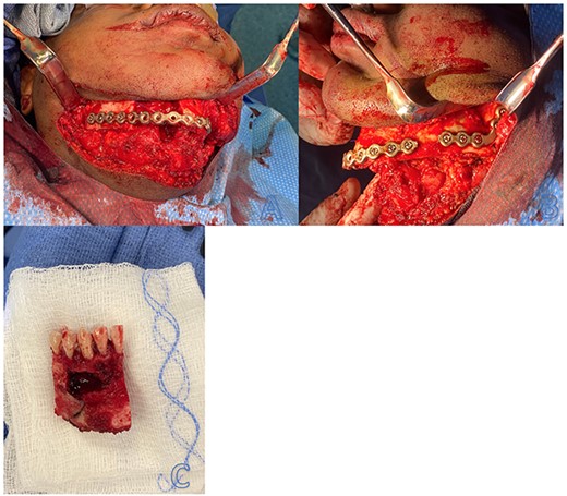 Intraoperative resection and repair of mandibular ossifying fibroma with pathologic fracture. (A) View of right segmental mandibulectomy with reconstruction using titanium reconstruction plate. (B) View of open reduction internal fixation of left mandibular angle fracture with titanium plate. (C) Resected ossifying fibroma.