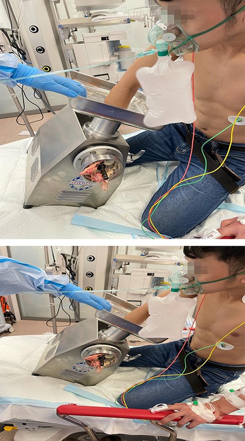 Shows the patient on arrival to the trauma room with the right upper limb trapped in the grinder machine.