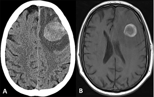 CT and MRI scans of the head indicating a large hemorrhagic enhancing lesion in the left frontal lobe with surrounding edema causing a rightward midline shift.
