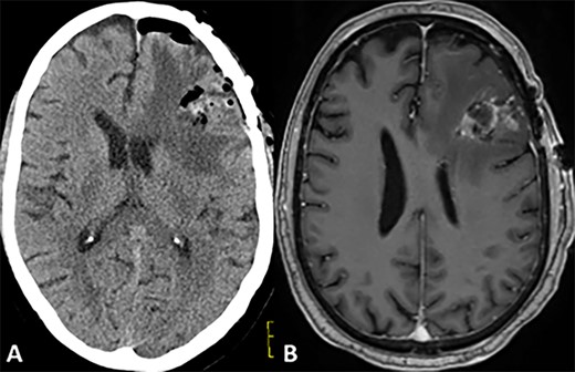 Postoperative CT and MRI scans of the head indicating complete tumor resection with reduced midline shift.
