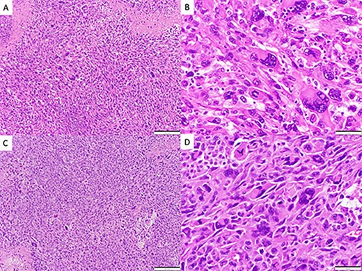 Spindle cell neoplasm with pleomorphic epithelioid features, multinucleation, mitoses and necrosis, involving pulmonary artery (A, B) and brain (C, D), H&E.