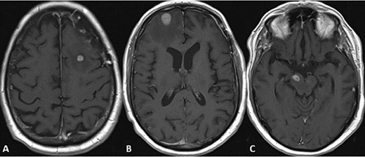 MRI scans indicating new metastatic lesions of the bilateral frontal lobes and right cerebral peduncle.