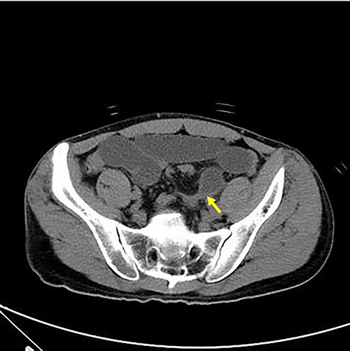 Axial view of abdominal CT revealing intersigmoid hernia with arrow indicating the leading point.