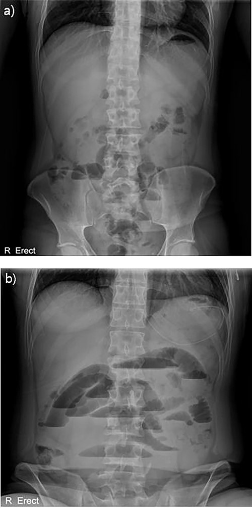 Abdominal X-ray findings (a) initial findings before admission; (b) 12-h follow-up findings revealing step ladder sign.
