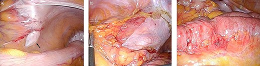 Laparoscopic findings (a) arrow indicating hernia orifice of the intersigmoid rescess; (b) wide opened hernia orifice; (c) laparoscopic finding of incarcerated segment of ileum.