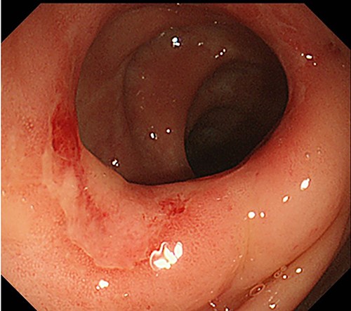 Preoperative colonoscopy findings; there was no evidence of active Crohn’s disease, such as ulceration, although erosions were noted.
