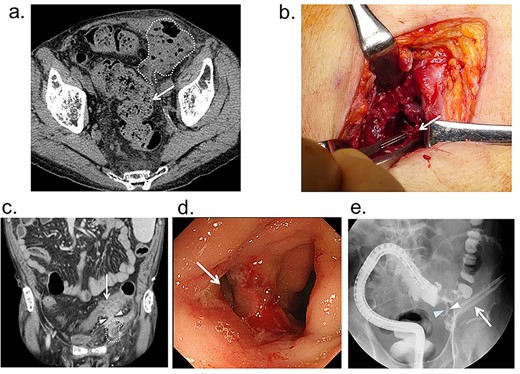 (a) Before drainage abdominal CT findings; abscess is found in the subcutaneous space and preperitoneal cavity of the left inguinal region (dotted-line circle), and it is adjacent to the sigmoid colon (arrow); (b) findings of emergency drainage; a portion of the Kugel patch (arrow) was firmly adherent to the abdominal wall, and the abscess cavity continued further into the mesh, but it was unclear whether it had reached the abdominal cavity; (c) CT findings after drainage: edematous changes in the sigmoid colon and a fistula continuous with the abscess cavity; (d) colonoscopy: ulceration and fistula (arrow) are found in the sigmoid colon; (e) lower gastrointestinal tract radiography findings after drainage: fistula is found (arrowhead) between the sigmoid colon and drainage tube (arrow).