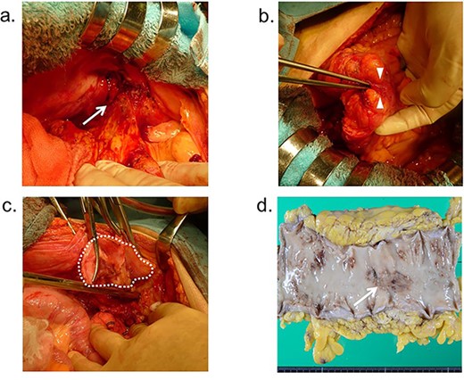 Operative findings; (a) the sigmoid colon adheres to the abdominal wall (arrow); (b) fistulous canal is observed between the sigmoid colon and Kugel mesh (arrowhead); (c) the mesh adheres severely to the peritoneum and posterior wall of the inguinal canal (dotted-line circle); (d) macroscopic findings; colonic ulcer was found in the resected specimen, and a fistula was found in the ulcer (arrow).