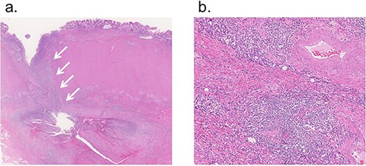 Microscopic findings; (a) fissuring ulcer was found in line with the fistula (12.5×, H&E, arrow); (b) transmural inflammation was detected in the colon wall surrounding the ulcer (100×, H&E).