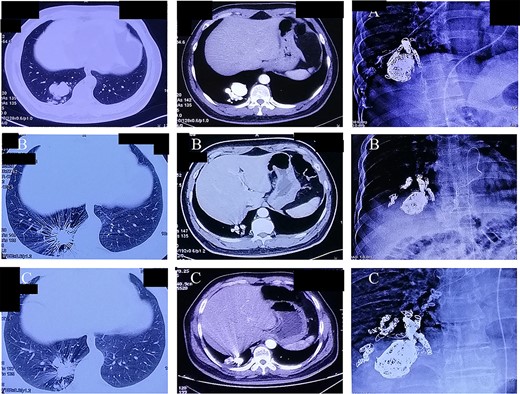 (A–C) Chest computer tomography and angiography on three times of pulmonary artery branch embolization.