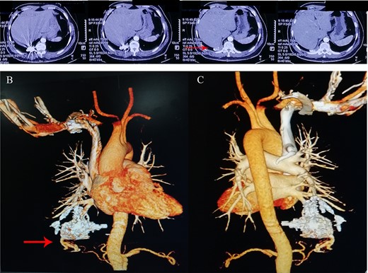 (A) A round density and local artifacts were observed in the lower lobe of the right lung on pre-operative computerized tomography; (B) anterior and (C) posterior 3D reconstruction showed a dilated and tortuous vessel structure in the right lower lobe.