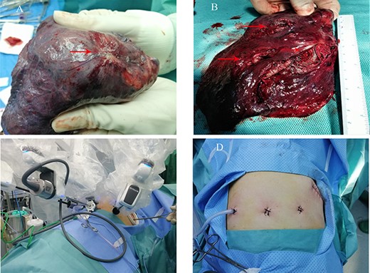 (A and B) The pathological specimen showed a large number of abnormally tortuous vascular masses and spring coils located on the distal side of the right lower lobe after the operation; (C and D) the location of a 4-cm assistive incision, two other instrument arm operation ports and a camera port on the lateral chest wall.