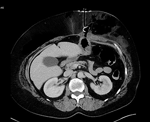 Internal retention bolster in subcutaneous tissue.